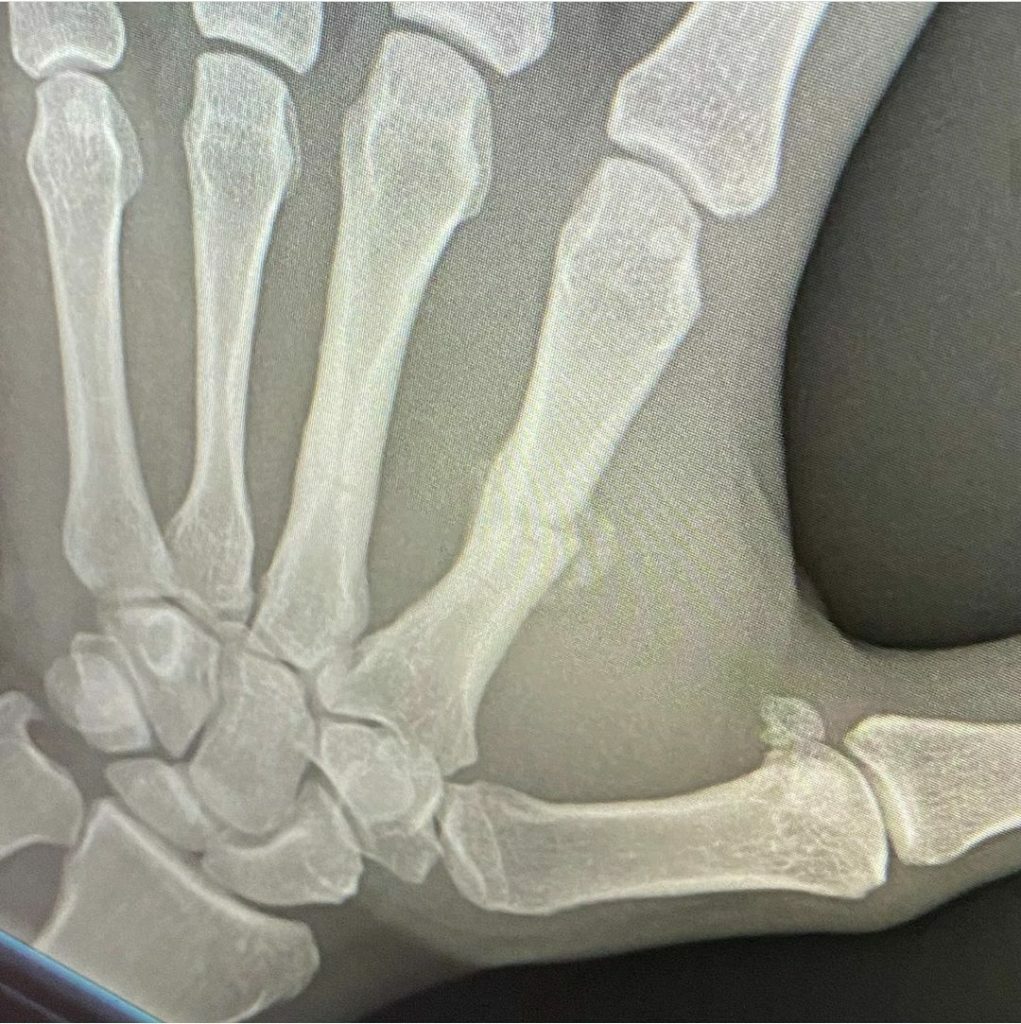 Sam Alvey's broken hand